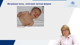 Ветряная оспа